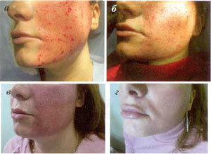 etapas da restauración da pel despois do procedemento de ablación fraccionada