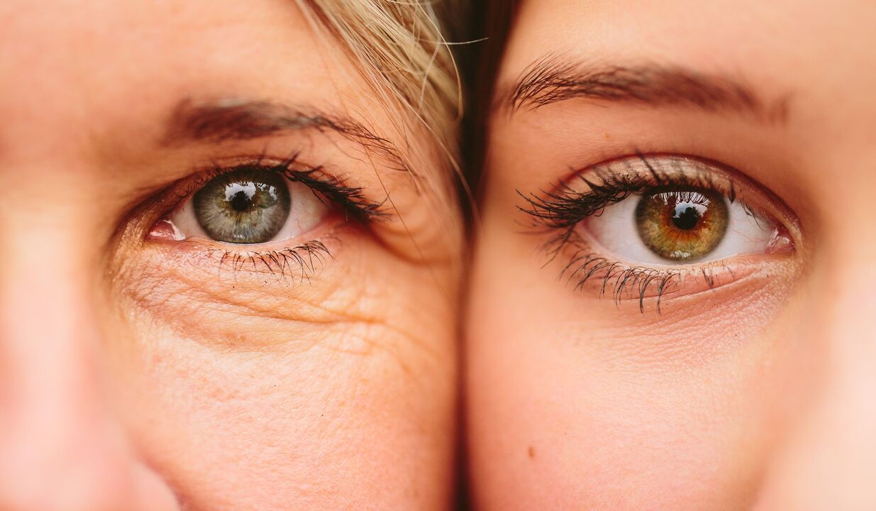 signos de envellecemento ao redor dos ollos