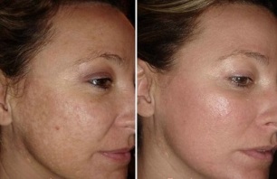 rexuvenecemento da pel láser antes e despois das fotos